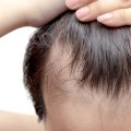 Natural Hair Loss Treatments: A Comprehensive Guide to Holistic Hair Restoration