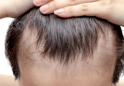 Natural Hair Loss Treatments: A Comprehensive Guide to Holistic Hair Restoration