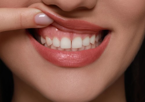 Gummy Smile Solutions: Advanced Treatments for Confident, Natural-Looking Smiles